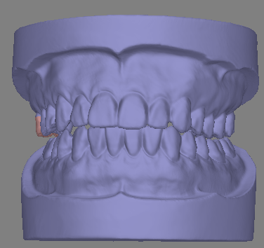 Визуализация первичного контакта челюстей в процессе жевания